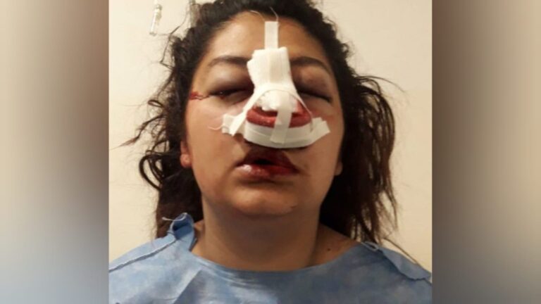 Denunció que su hija recibió un piedrazo en la cara