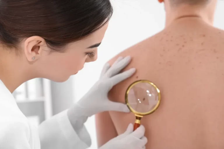 El cáncer de piel causa la muerte de 57.000 personas por año en el mundo