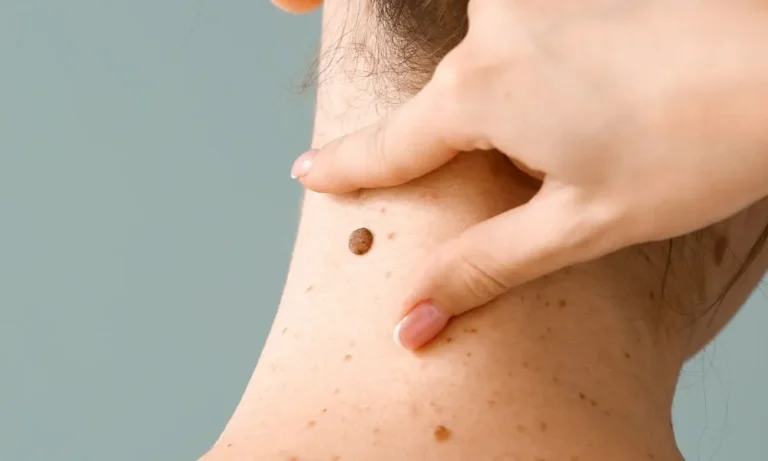 LALCEC lanzó un Campaña de Prevención del Cáncer de Piel