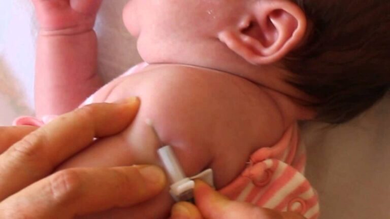 Incorporación de la vacuna neonatal BCG en clínicas privadas
