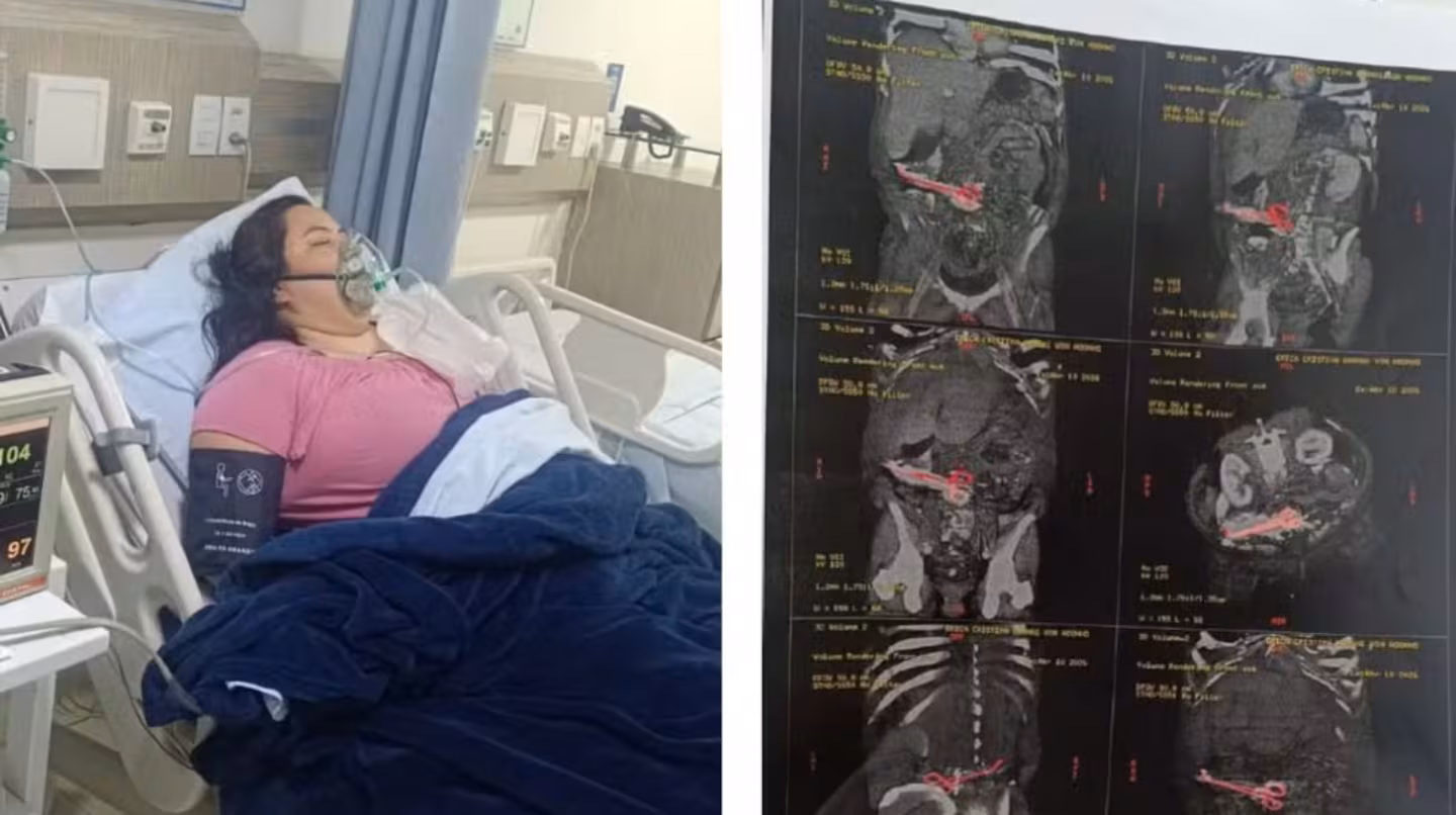 Erica cristina bannai von hoonholtz estuvo cerca de tres meses con una pinza quirurgica en el cuerpo foto gentileza g1 VZM6JRT6HNBQXHIGIJRUECQUA4